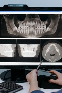 Ein Zahnarzt zeigt auf ein digitales Röntgenbild, das die Struktur der Zähne und des Kiefers detailliert darstellt. Das Bild veranschaulicht die Wichtigkeit von Diagnosetools bei der CMD-Behandlung.