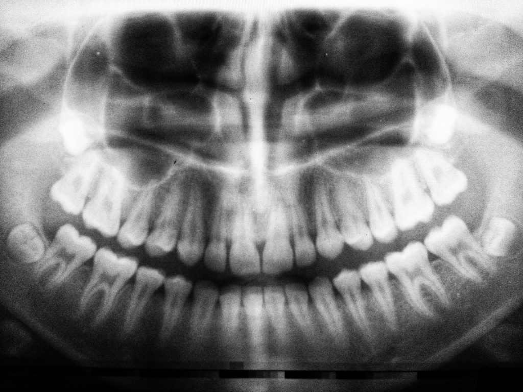 Röntgenbild eines Gebisses – Diagnose von CMD und deren Auswirkungen auf die Zahngesundheit.